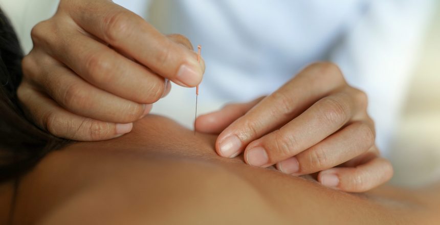 Dry Needling Vs. Acupuncture: The Facts To Know